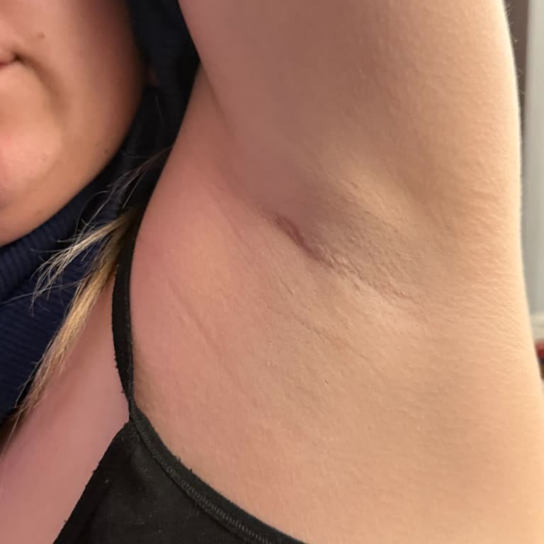 Yves Rocher Deodorantın Ciltte Yarattığı Tahriş Ve Kaşıntı Sorunu