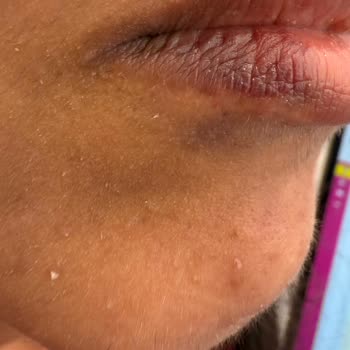 Esterella Estetik'te Hayal Kırıklığı: Dudak Dolgusu Deneyimi