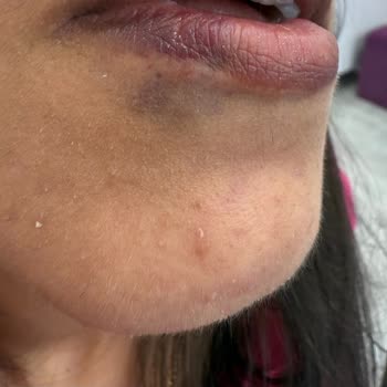 Esterella Estetik'te Hayal Kırıklığı: Dudak Dolgusu Deneyimi