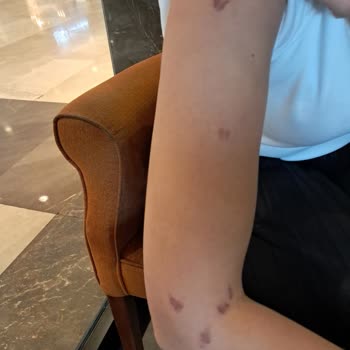 Lazer İşleminde Yanık Ve Sürekli Danışman Değişikliği