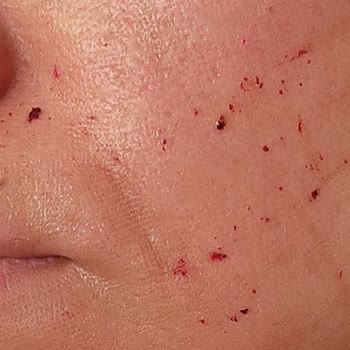 CO2 Lazer İşlemi Sonrası Cilt Sorunları