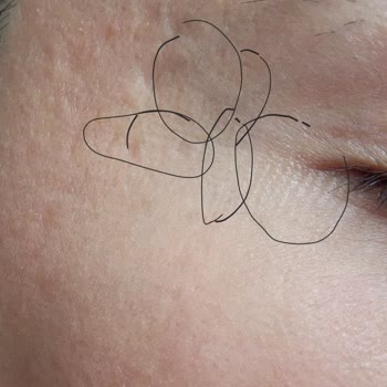 CO2 Lazer İşlemi Sonrası Cilt Sorunları