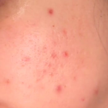 Cilt Bakım Ürünleri Sivilcelerimi Azaltmak Yerine Arttırdı