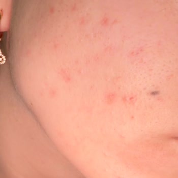 Cilt Bakım Ürünleri Sivilcelerimi Azaltmak Yerine Arttırdı