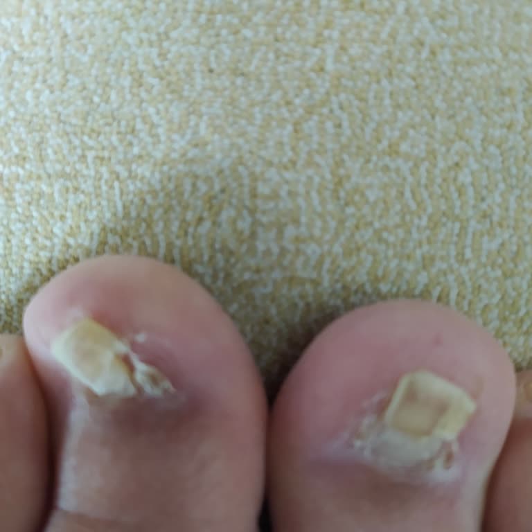 Tırnak Tedavisi Mağduriyeti: Sağlığım Ve Param Ziyan Oldu