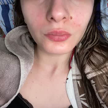 Sebo Active Clear Tonik Ciltte Kızarıklık Ve Yanma Yaptı