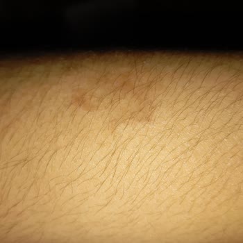 Eti Gıda Popkek Tüketimi Sonrası Alerjik Reaksiyon