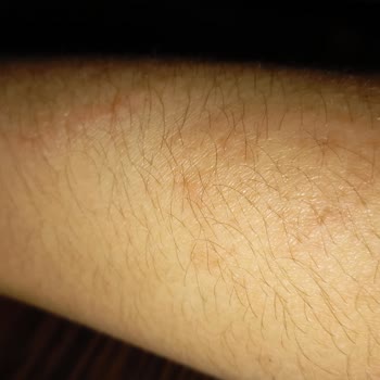 Eti Gıda Popkek Tüketimi Sonrası Alerjik Reaksiyon
