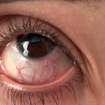 Lavinya Nail Beauty İpek Kirpik Uygulaması Sonrası Sağlık Sorunları ve Kötü Hizmet Deneyimi