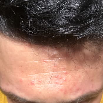 Vichy Serum, Kollagencreme und Augencreme Hautirritationen und Aknebildung