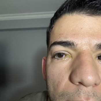 Tuğba Yeşilova Güzellik Az Kalsın Gözlerimden Oluyordum