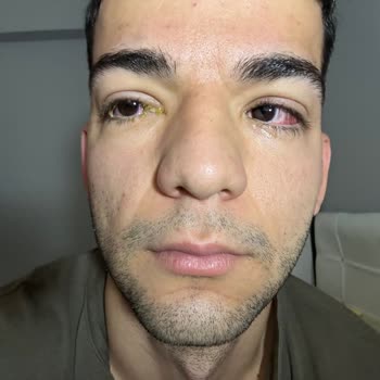 Tuğba Yeşilova Güzellik Az Kalsın Gözlerimden Oluyordum