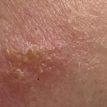 Cildimi Yakan Güneş Koruyucu Ürünü