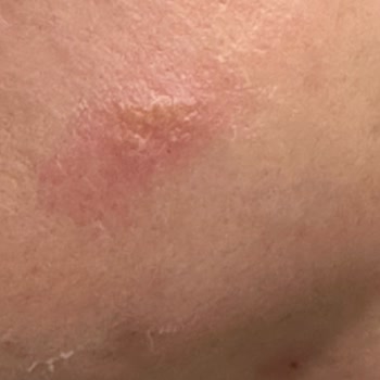 Cildimi Yakan Güneş Koruyucu Ürünü