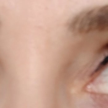 Acuvue Oasys Lenslerde Rahatsızlık Ve Kanlanma Sorunu