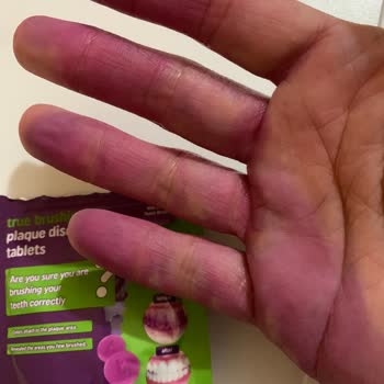 Diş Beyazlatıcı Ürün Ciltte Kalıcı Leke Bıraktı