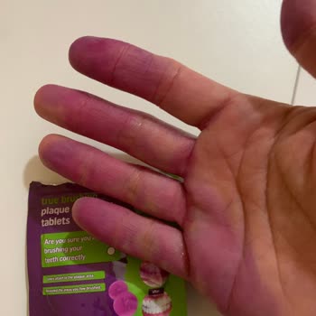 Diş Beyazlatıcı Ürün Ciltte Kalıcı Leke Bıraktı