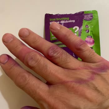 Diş Beyazlatıcı Ürün Ciltte Kalıcı Leke Bıraktı