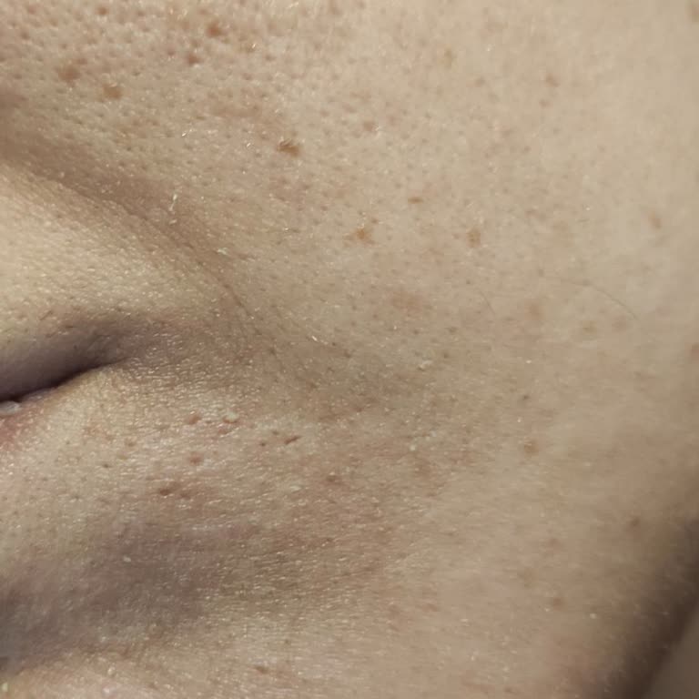 Cilt Tahrişine Sebep Olan Bozuk Güneş Kremi