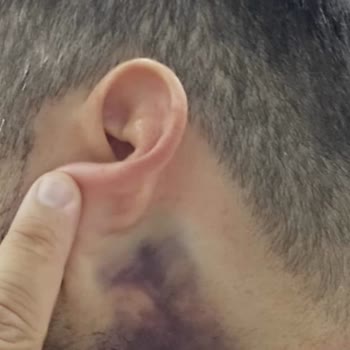 Gıdı Lipo İşleminde Kalıcı Hasar Ve İletişim Sorunu