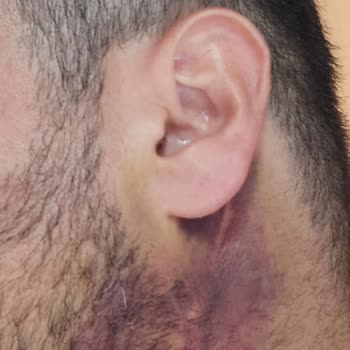 Gıdı Lipo İşleminde Kalıcı Hasar Ve İletişim Sorunu