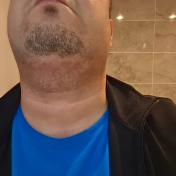 Gıdı Lipo İşleminde Kalıcı Hasar Ve İletişim Sorunu