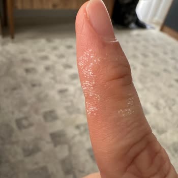 Kimyasal Yanık Tehlikesi: Uyarı Eksikliği