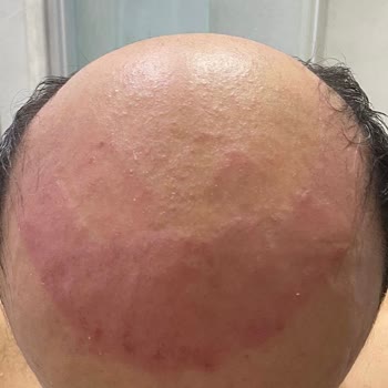 Hairlife International Saç Protezi Deneyiminde Beklentiler Karşılanmadı