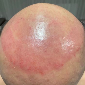 Hairlife International Saç Protezi Deneyiminde Beklentiler Karşılanmadı