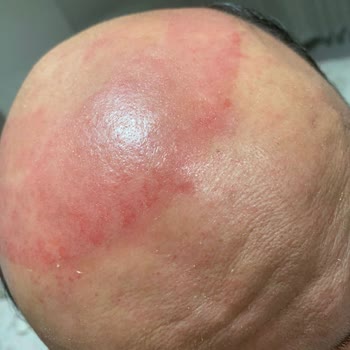 Hairlife International Saç Protezi Deneyiminde Beklentiler Karşılanmadı