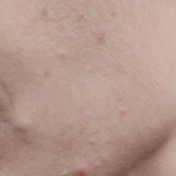 I Used La Roche-Posay Sunscreen and It Gave Me Itching, Burning, and Skin Bumps