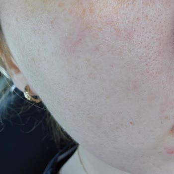 La Roche-Posay Lipikar Baume Caused Allergic Reaction—Still Waiting for Refund