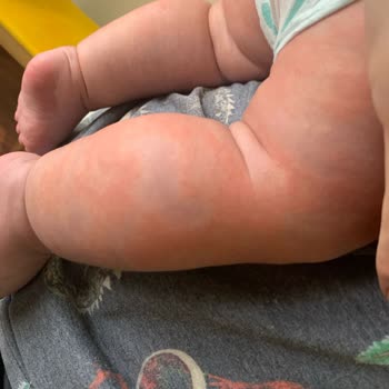 Mustela Kremi Ciltte Kızarıklık Ve Tahrişe Sebep Oldu