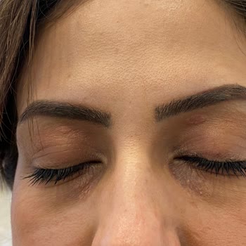 Loreal Paris Loreal Göz Serumu Ciltte Tahrişe Neden Oldu