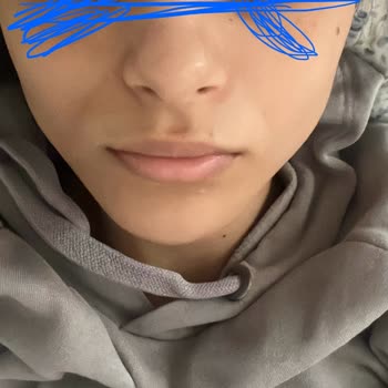 Serrasmed Clinic Çeneme Dolguyu Yamuk Yaptı