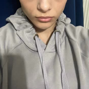 Serrasmed Clinic Çeneme Dolguyu Yamuk Yaptı