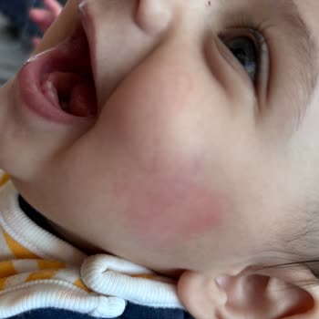 Mustela Ürünü Beklenmedik Reaksiyona Sebep Oldu