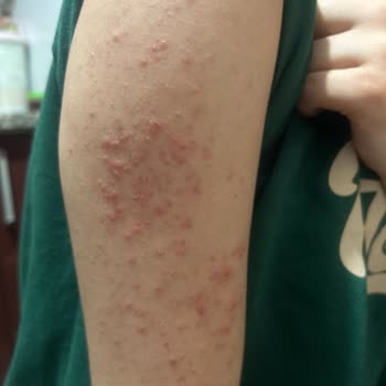 Ağda Sonrası Şiddetli Alerji Deneyimi