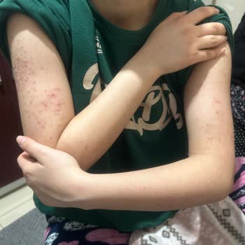 Ağda Sonrası Şiddetli Alerji Deneyimi