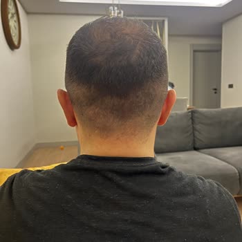 Saç Çoğaltma Seansları Hayal Kırıklığı Yarattı