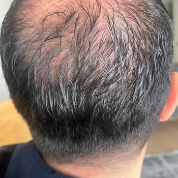 Saç Çoğaltma Seansları Hayal Kırıklığı Yarattı