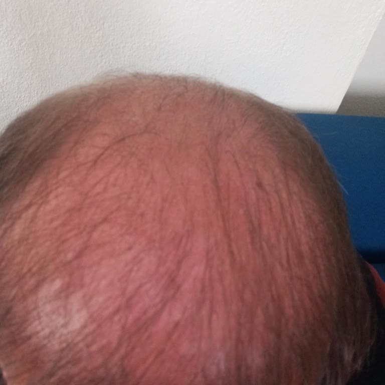 Saç Ekiminde Hayal Kırıklığı