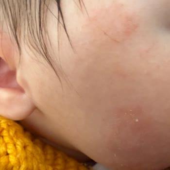 Hypoallergenic Krem Cilt Reaksiyonu Yarattı