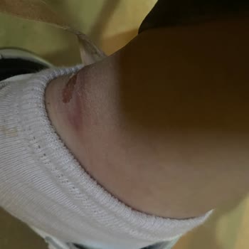 Adidas Ayakkabı Ayağımı Yaraladı