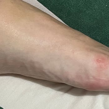 Elle Ayakkabı Ayağımı Yaralıyor Ve Çözüm Bulunamıyor
