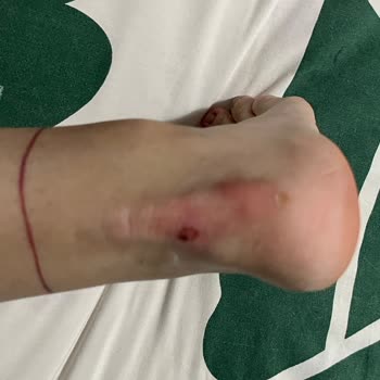 Elle Ayakkabı Ayağımı Yaralıyor Ve Çözüm Bulunamıyor