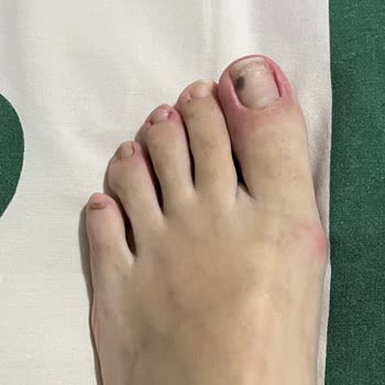 Elle Ayakkabı Ayağımı Yaralıyor Ve Çözüm Bulunamıyor