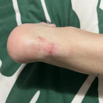 Elle Ayakkabı Ayağımı Yaralıyor Ve Çözüm Bulunamıyor