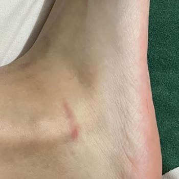 Elle Ayakkabı Ayağımı Yaralıyor Ve Çözüm Bulunamıyor