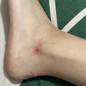 Elle Ayakkabı Ayağımı Yaralıyor Ve Çözüm Bulunamıyor